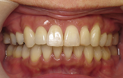 術後口腔内写真