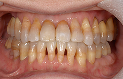 術後口腔内写真