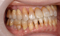 術後口腔内写真
